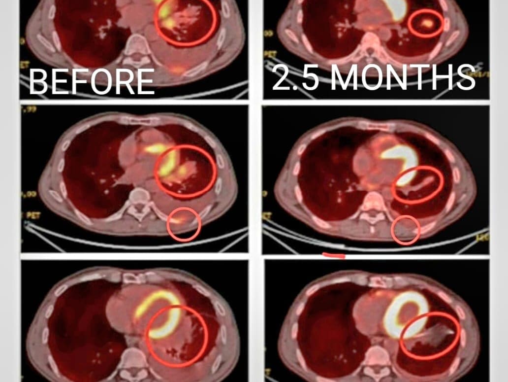 Brainstem cancer patient who recovered with ECCT treatment