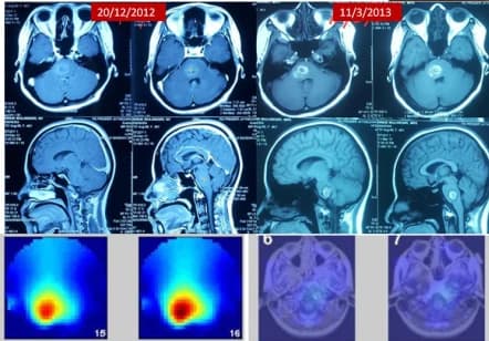 Terminal brainstem cancer patient who recovered with ECCT